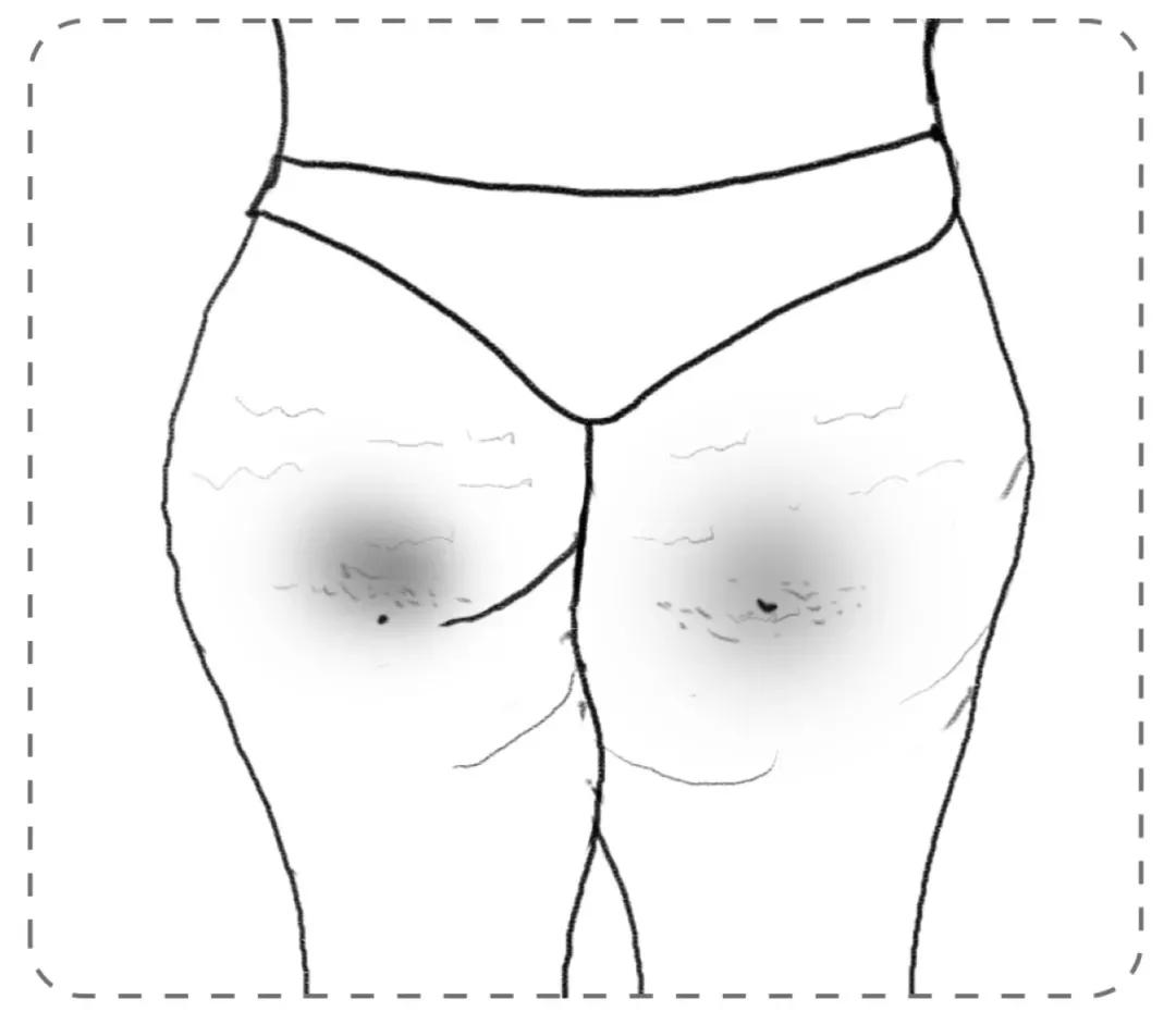 屁股坐的位置起大疙瘩怎么回事,屁股坐久了有黑圈怎么办