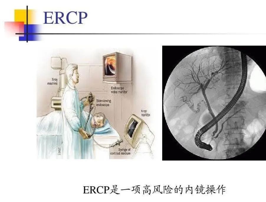 消化内镜技术近5年的新进展,腹腔镜下胆总管切开取石术恢复快