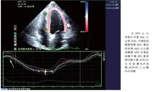 超声能查出心脏病吗,超声冠心病