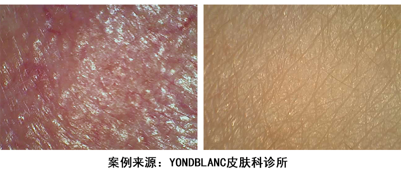 护肤小知识刺痛发红缺水,护肤皮肤刺痛是缺水吗