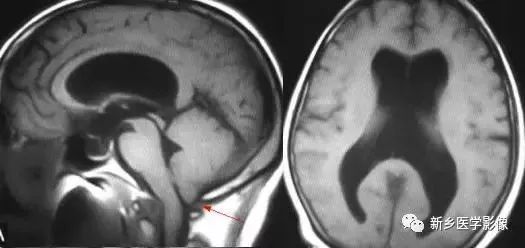 脑室影像学表现,脑室占位影像