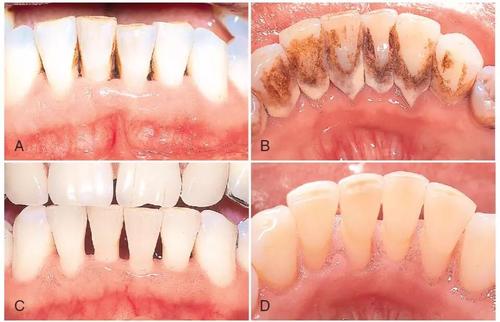 一个职业口腔科医生帮你分析洗牙的利弊
