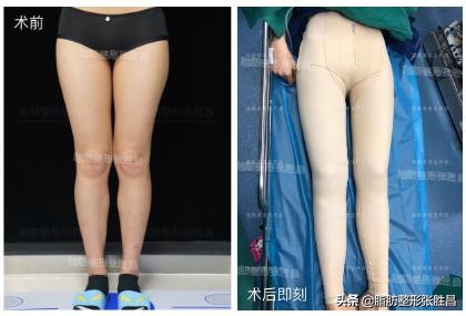 大腿吸脂后可以穿一般的紧身裤吗,大腿吸脂一个多月紧身裤还要穿吗