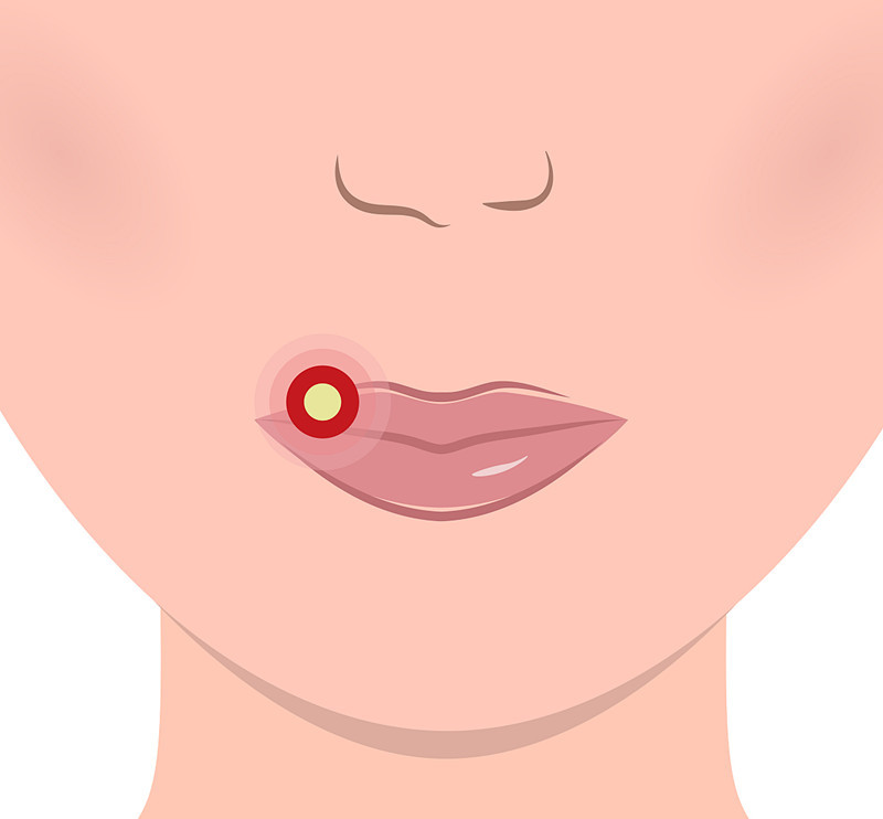 疱疹有可能长一颗吗,疱疹长满全身就会死吗