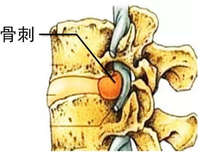 颈椎病一走路就头晕很痛苦,脊髓型颈椎病病人痛苦吗