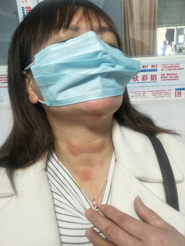 穴位注射治疗慢性咽喉炎图片,治疗咽喉炎扎针有效果吗