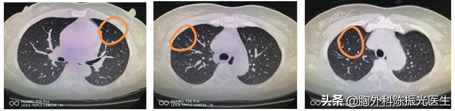 艾灸什么穴位可以消除肺结节,肺上有结节艾灸可以吗