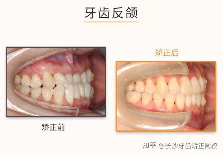 长沙口腔医院反颌矫正,长沙牙齿反颌矫正脸型改变