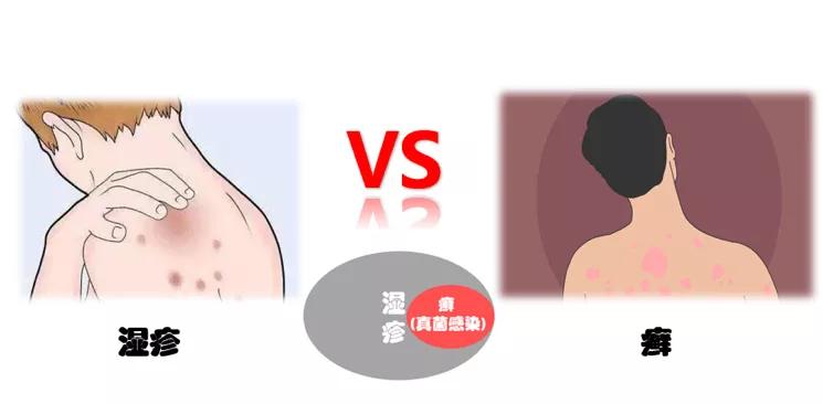 手癣和湿疹合并怎么治,湿疹和癣能一起用药吗