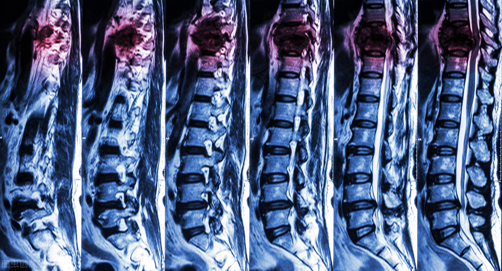 颈椎病严重了会导致瘫痪吗,颈椎病什么情况会导致瘫痪