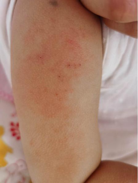 打完疫苗贴土豆片,打疫苗的地方疼可以贴土豆片吗