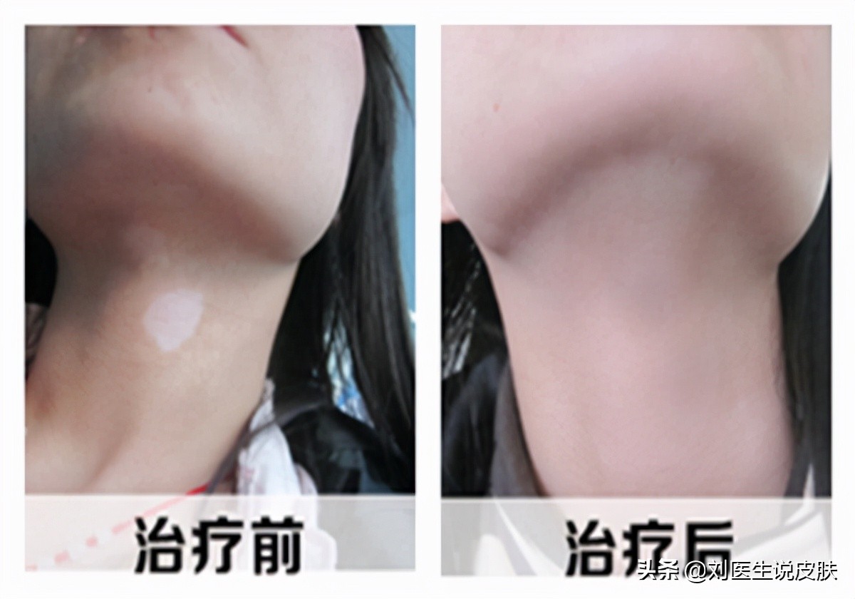 三天治好白癜风的疗法,白癜风白斑变红要治疗多久