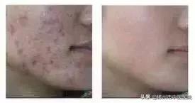 有一颗痘痘但还没长出来怎么办,很深的痘痘长不出来