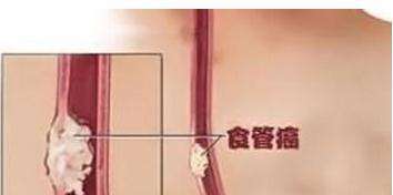 食道癌应该吃的食物,80岁老人得了食道癌饮食吃什么好