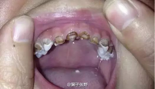 修复一颗蛀牙的全过程,蛀牙早期黑点全治好了的感觉真好