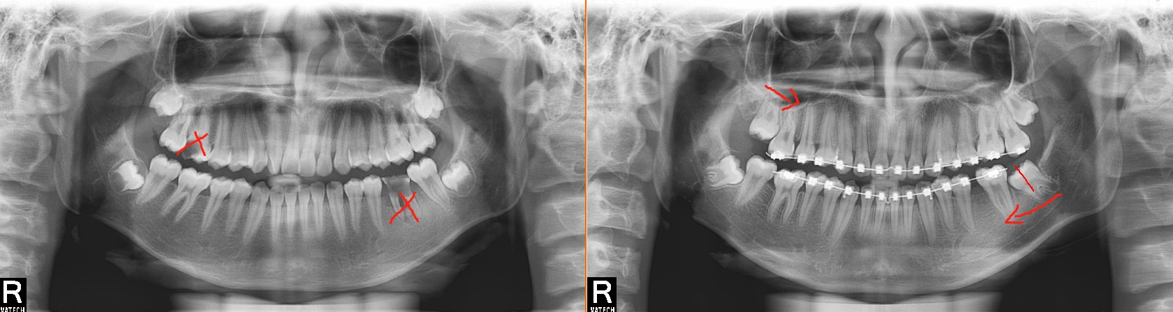 后磨牙可以拔掉吗,后磨牙可以装活动义齿吗