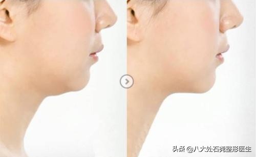 下巴脂肪堆积的解决方法,下巴脂肪过多怎么办