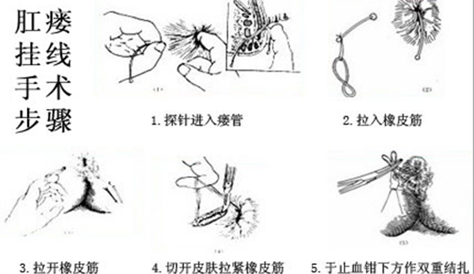 肠炎肛瘘的症状及治疗,肛瘘引起的脓包怎么办