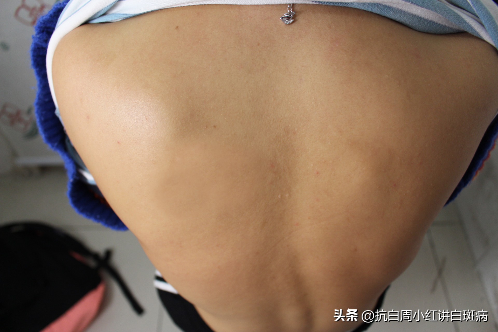 白癜风患者治好的全过程,白癜风治愈患者分享痊愈经验