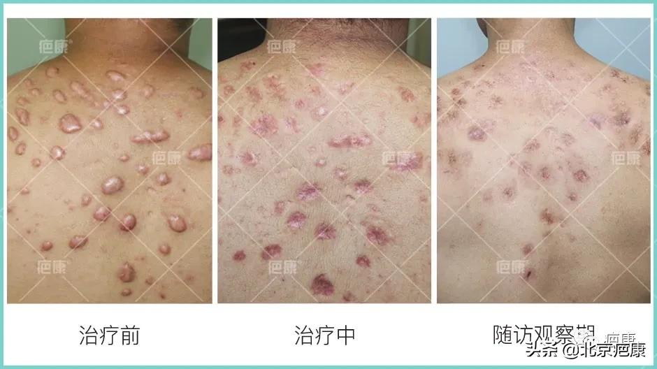 疤痕修复美容仪器多少钱,疤痕增生最好的仪器