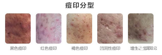 痘印红色的好治还是黑色的好治,红色痘印黑色痘印