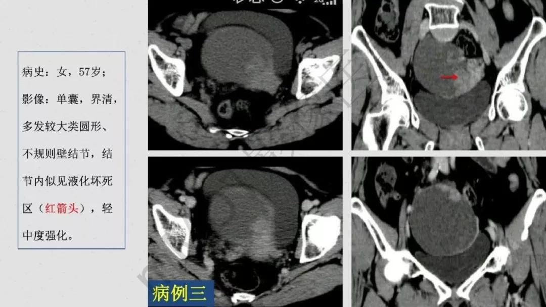 卵巢原发肿瘤的分析思路