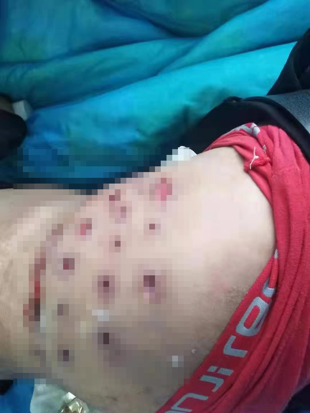 诊所扎针出事,扎针医疗事故