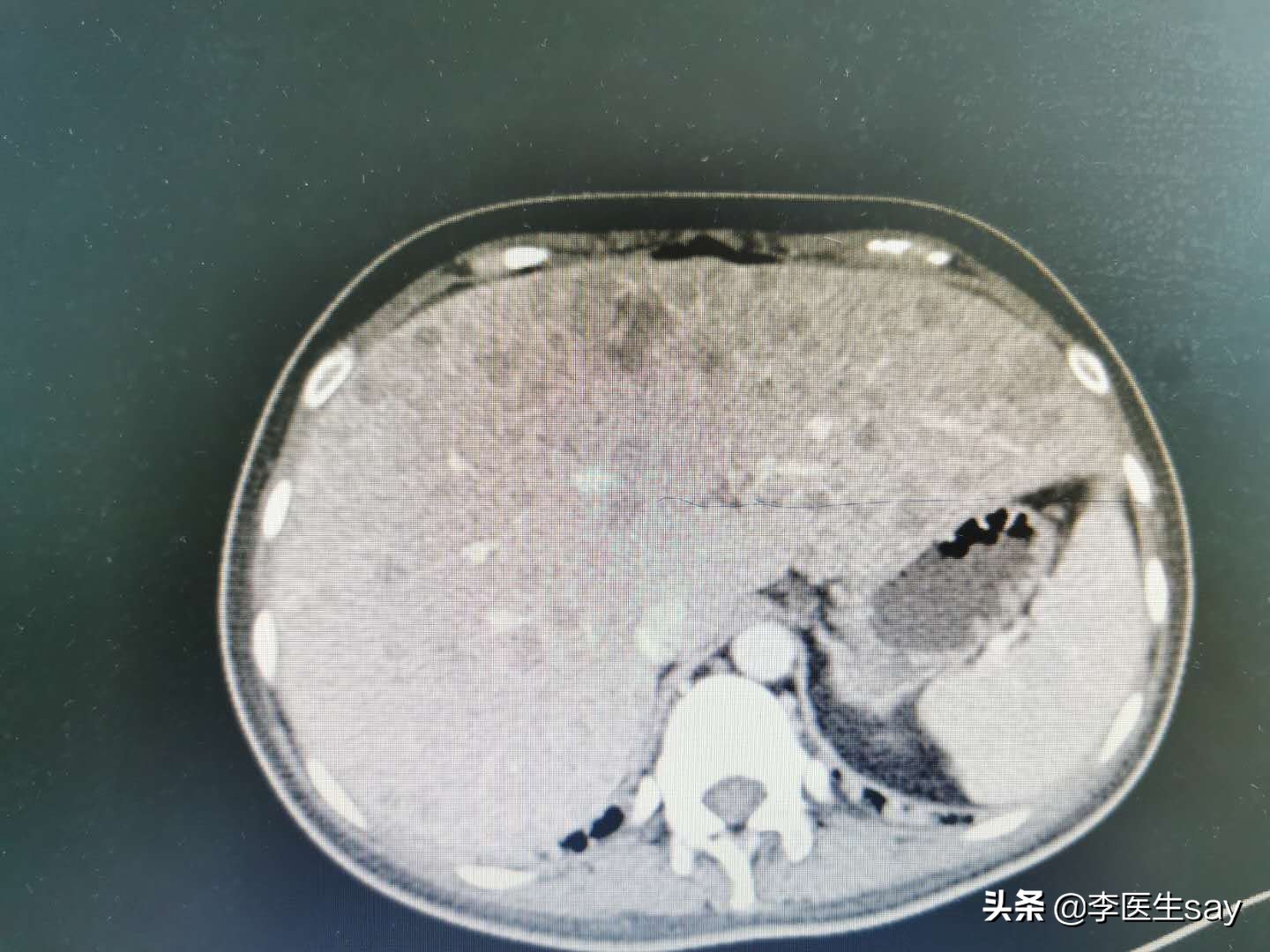 记录一个姑娘的最后一程,记录一个女孩的一生