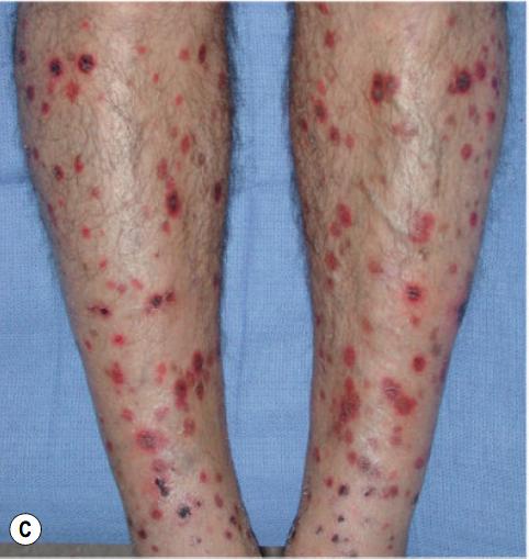 过敏性紫癜算是风湿病的一种吗,风湿性关节炎与过敏性紫癜区别