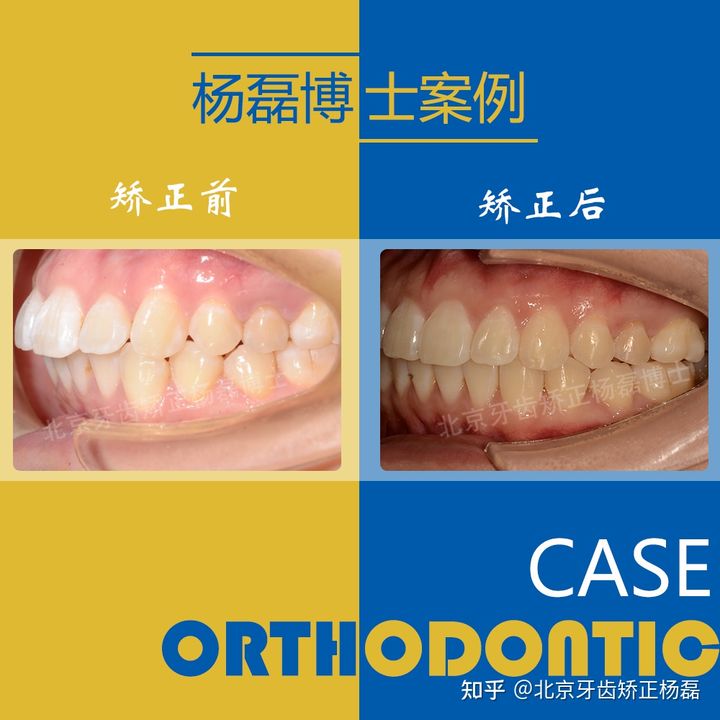 北京牙齿深覆合矫正推荐,重度拥挤牙齿矫正案例不拔牙