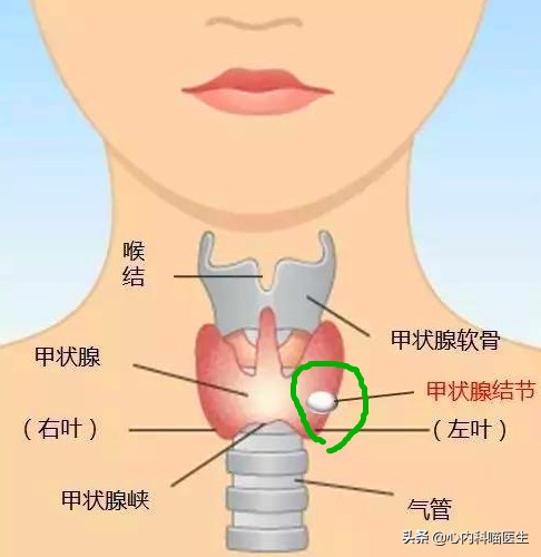 甲状腺结节癌症切除后能活多久,甲状腺结节伴有淋巴结节是癌症吗