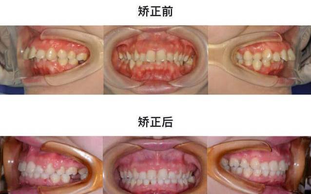 龅牙牙齿矫正的最佳方法,龅牙凸嘴露龈笑