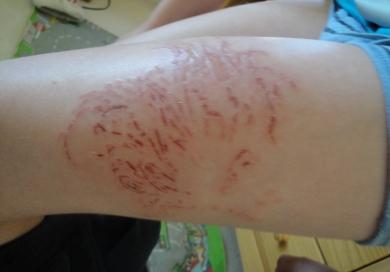 澳洲箱水母是世界上最毒的水母吗,箱形水母是最毒的动物吗