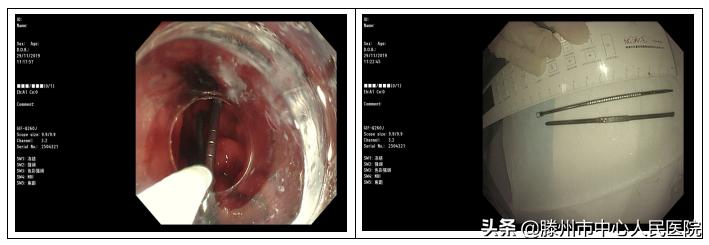 内镜下成功取出食管异物,消化内科取异物