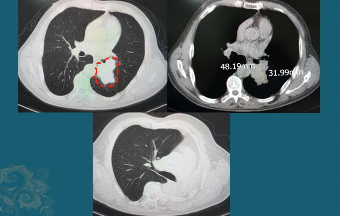 新冠肺部感染应对,新冠肺癌抗癌