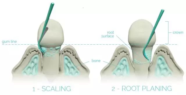 为什么洗牙价格相差这么大,普通洗牙和舒适洗牙有什么区别