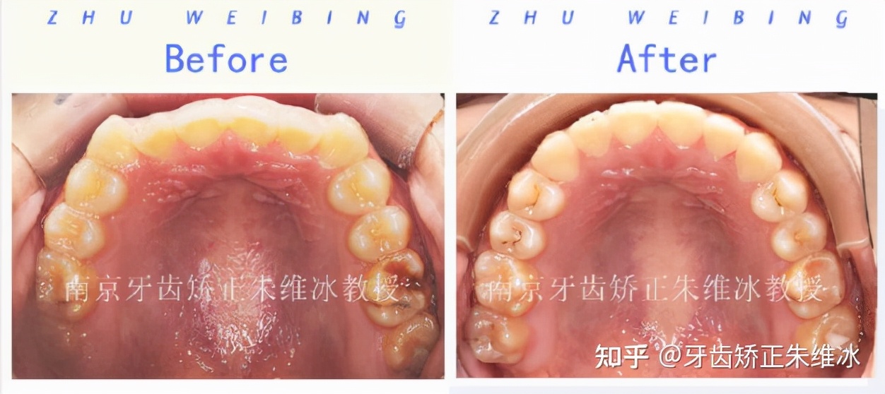 南京透明式牙齿矫正器地包天,18岁功能性地包天能改善面型吗