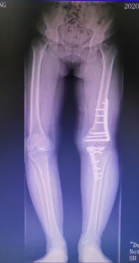 股骨和胫骨双部位截骨拯救复杂膝关节内翻畸形