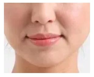 少年法令纹和痘坑显老,显老元凶法令纹