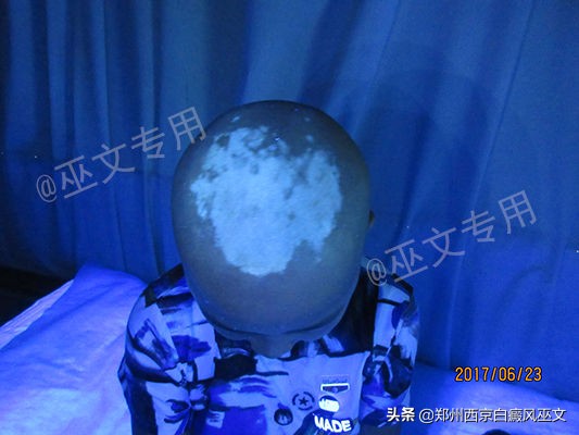 白癜风黑色素培植手术复发率高吗,黑色素种植术治疗白癜风的全过程