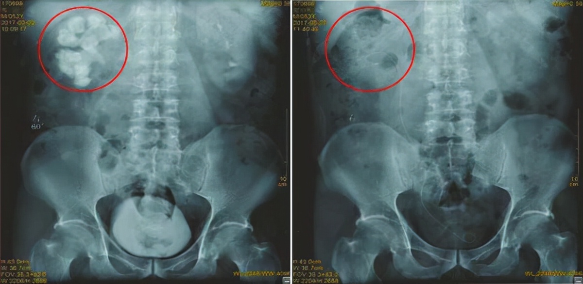 做完体外碎石为什么总大便,体外碎石后出现结石的原因