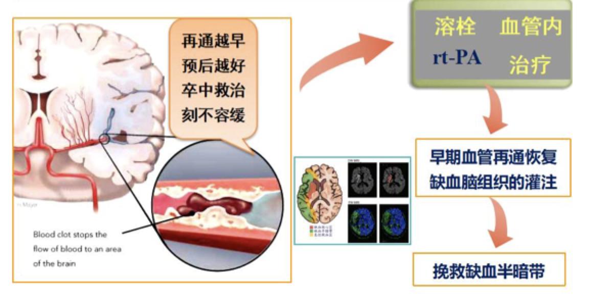 如果脑血管有血栓怎么治疗最好,老人脑血管堵塞最快消除方法