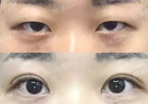 欧式大双眼皮和平行双眼皮,醒醒吧明智的放弃胜过盲目的执着