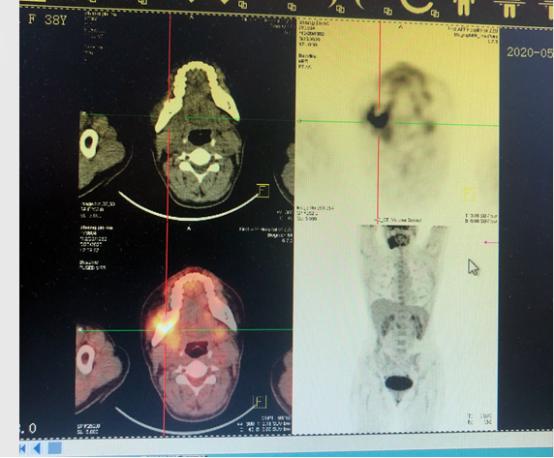 最新肺癌治疗指南,徐经世论治肺癌经验