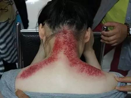 刮痧留下的印,刮痧后的痧怎么消得快