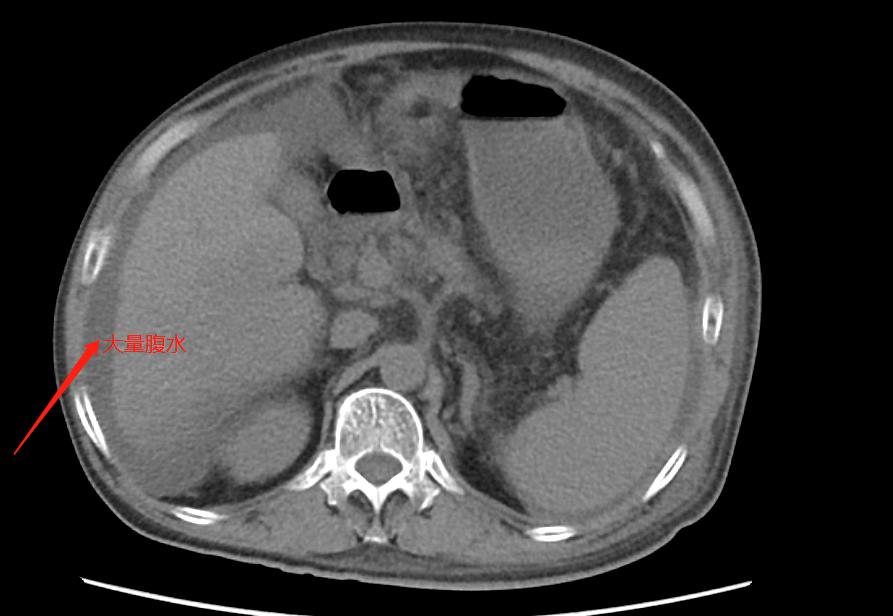老人肝炎腹胀,25岁小伙腹痛肝癌晚期