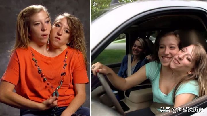 世界上最诡异的双头连体人,两个大脑如何控制同一个身躯