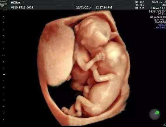 孕期抽烟会导致胎儿畸形吗,孕妇抽烟喝酒无创过了还会畸形吗