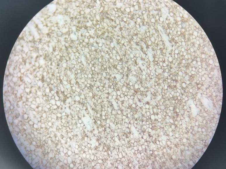 罕见肿瘤中医治疗案例视频,罕见肿瘤中医治疗案例