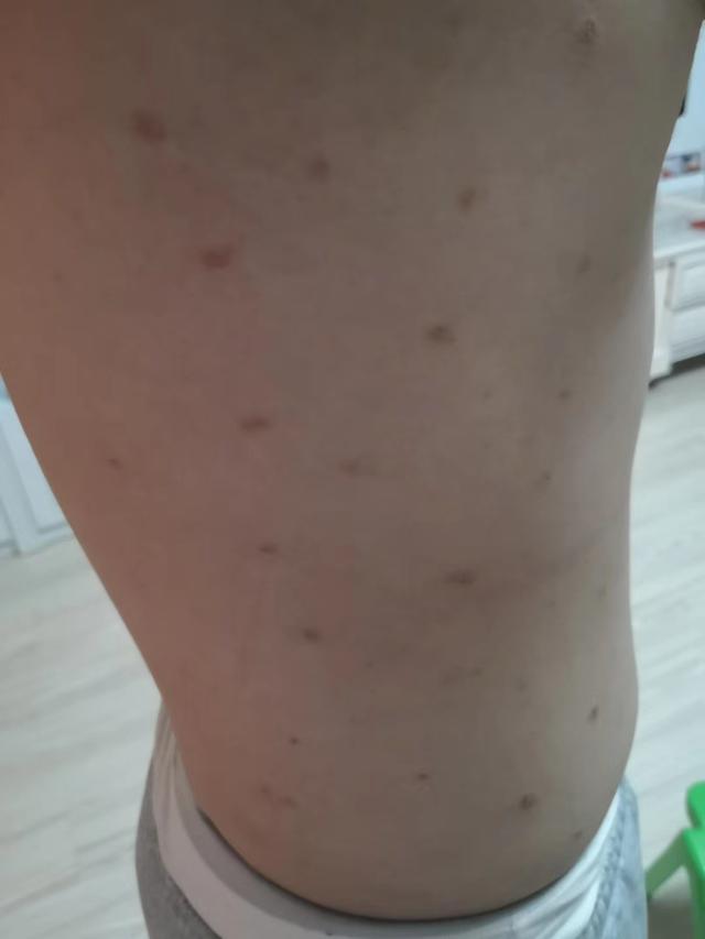 中医治疗皮肤痒的最好方法,中医治疗皮肤纤维瘤